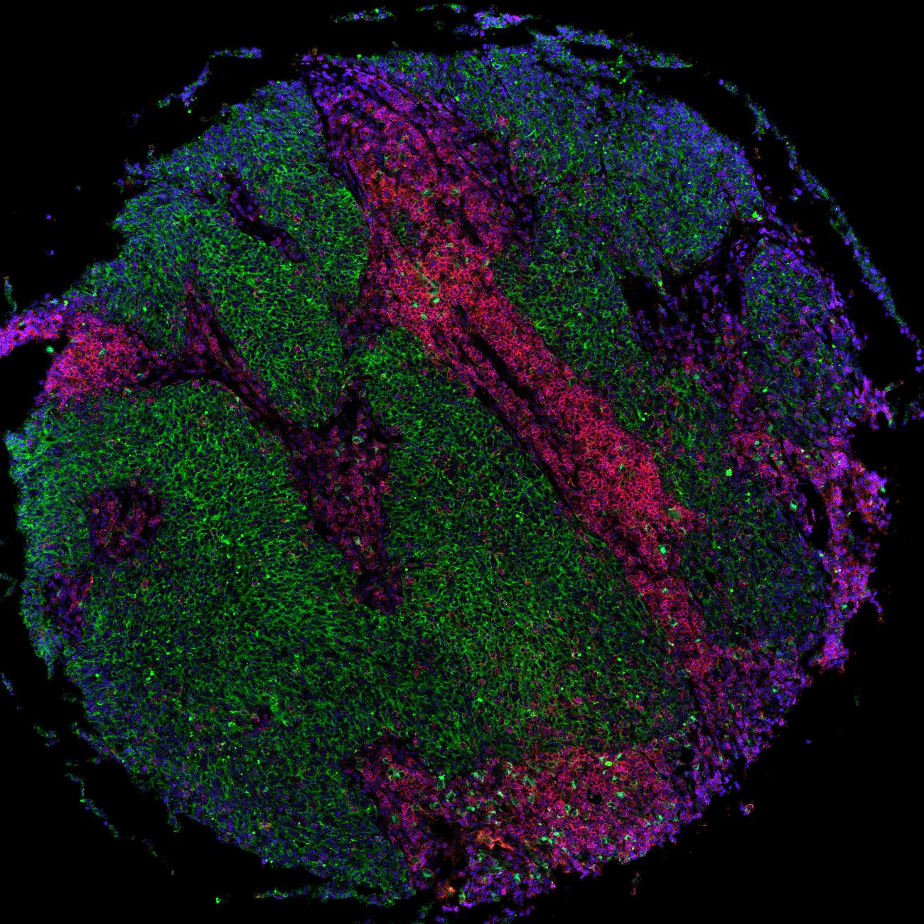 Lung tissue microarray core